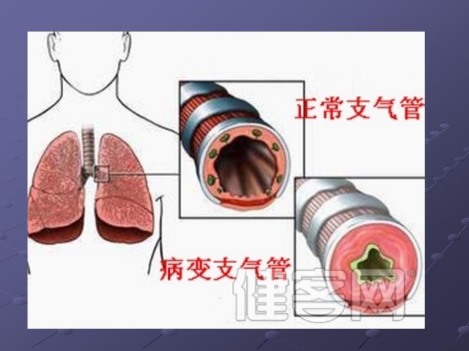 支气管扩张症护理查房资料课件_第3页