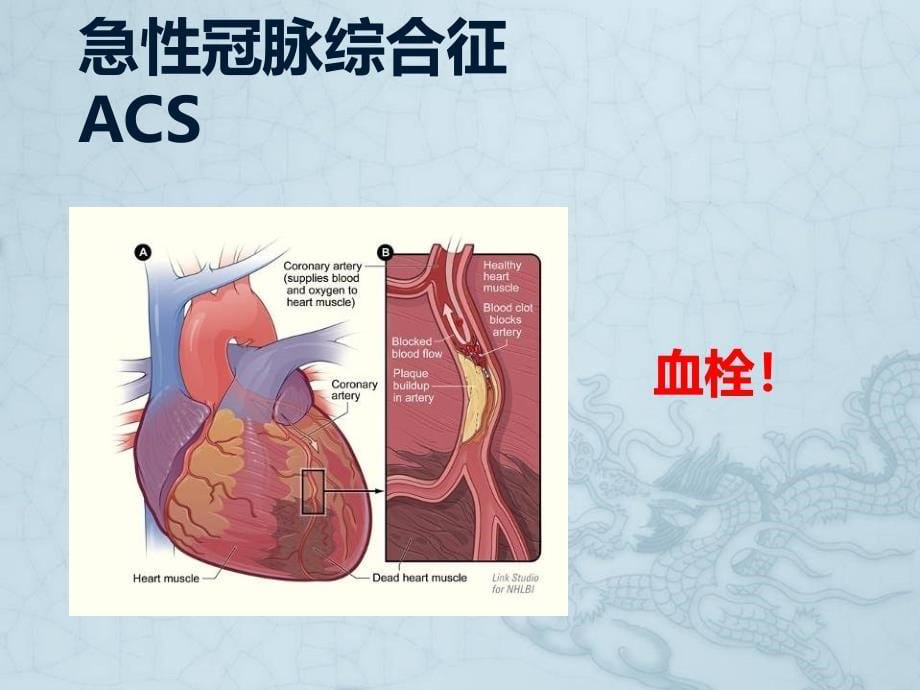 《胸痛三联症致命性胸痛诊断思维和处理策略》课件_第5页