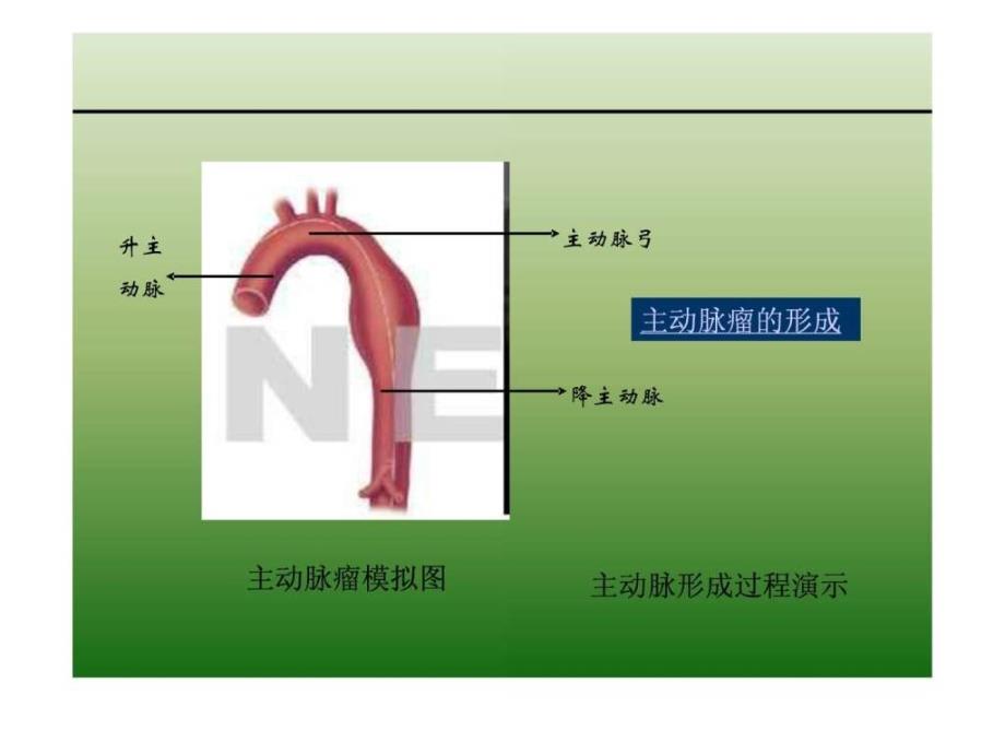 主动脉瘤和直管支架图文课件_第3页