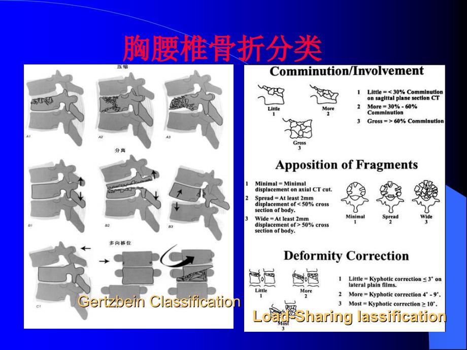 胸腰椎骨折微创治疗策略课件_第2页