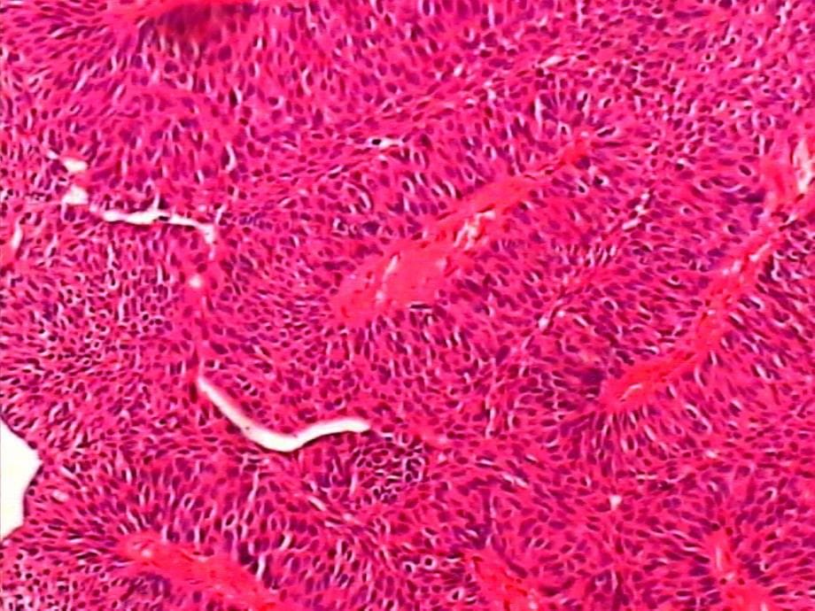 外科学多媒体课件 膀胱肿瘤_第5页