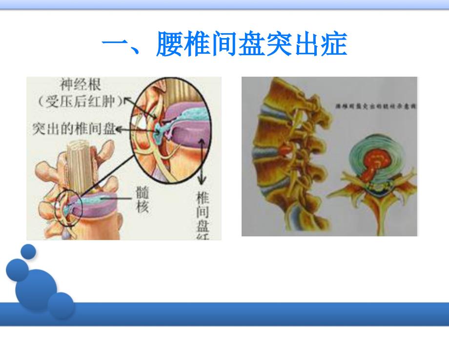 下腰痛的康复护理课件_第4页