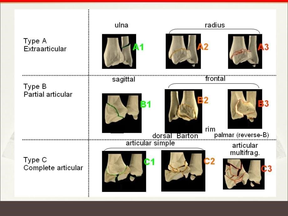 切开复位内固定及手法复位夹板外固定治疗a3型桡骨远端骨折的疗效比较课件_第5页