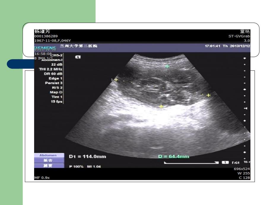 脐尿管囊肿超声诊断课件_第4页