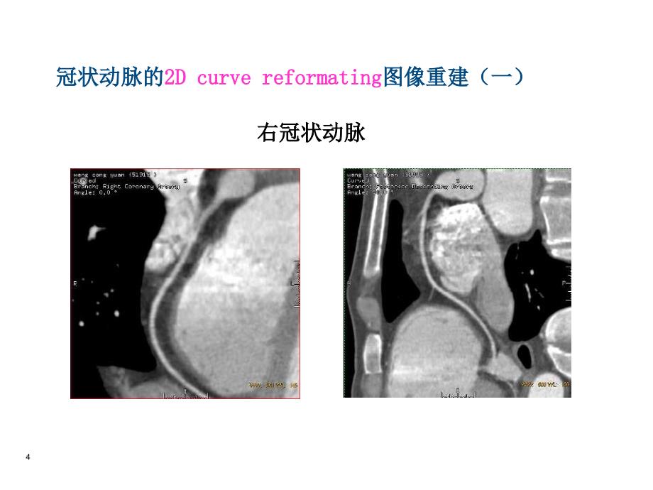 多层螺旋ct冠状动脉成像的临床应用课件_第4页