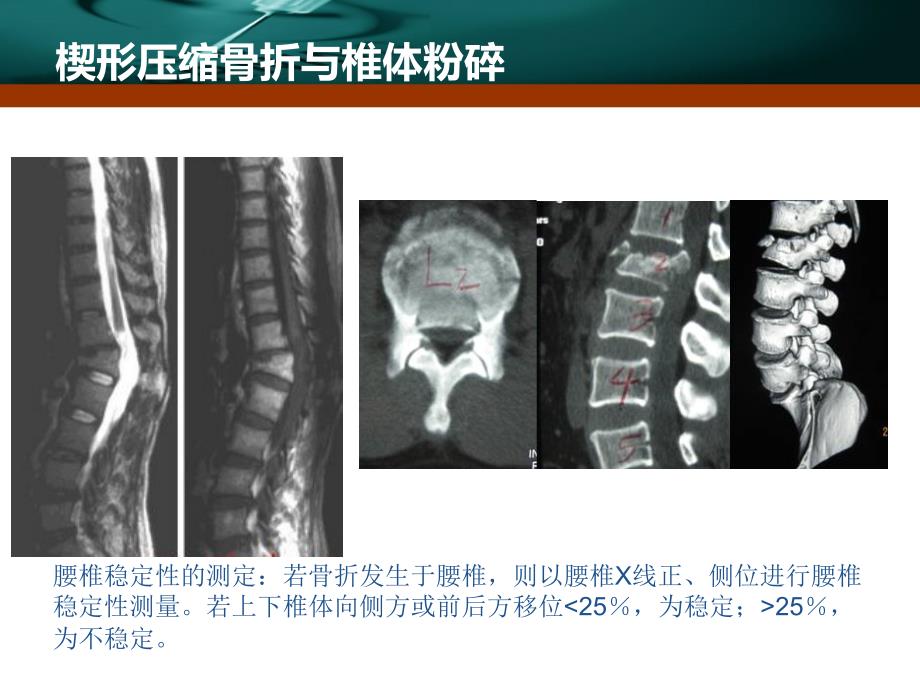 脊柱骨折课件_7_第4页