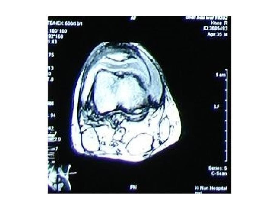 关节镜治疗青少年膝关节结核课件_第5页