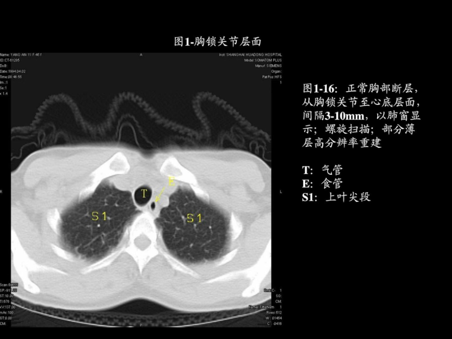 胸部ct的正常结构及肺部疾病的影像学表现课件_第1页