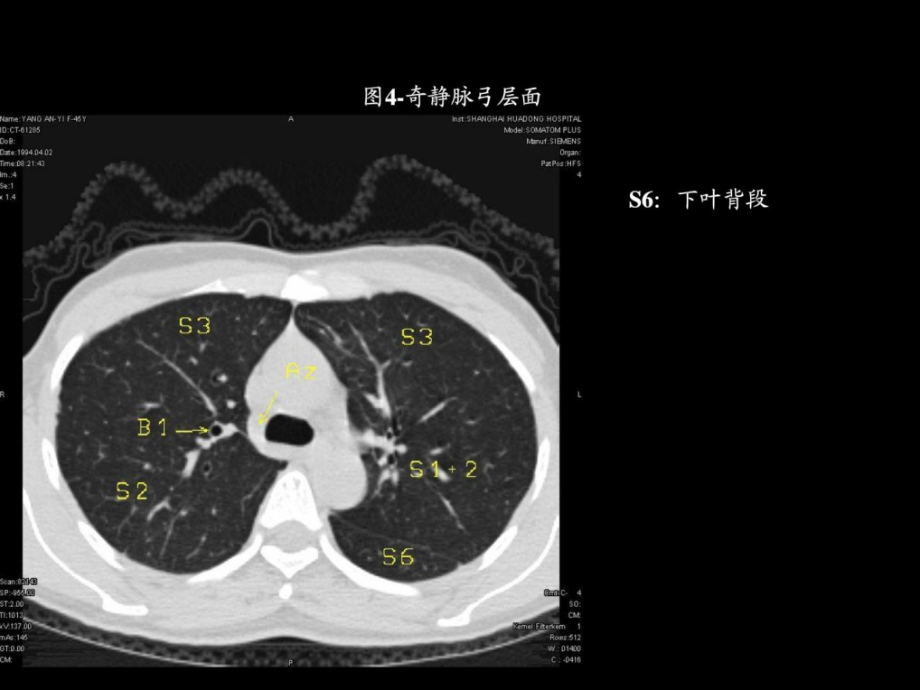 胸部ct的正常结构及肺部疾病的影像学表现课件_第4页