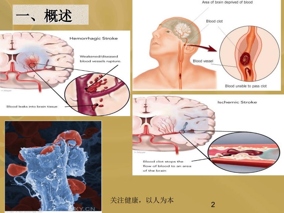 缺血性脑卒中的二级预防课件_第2页