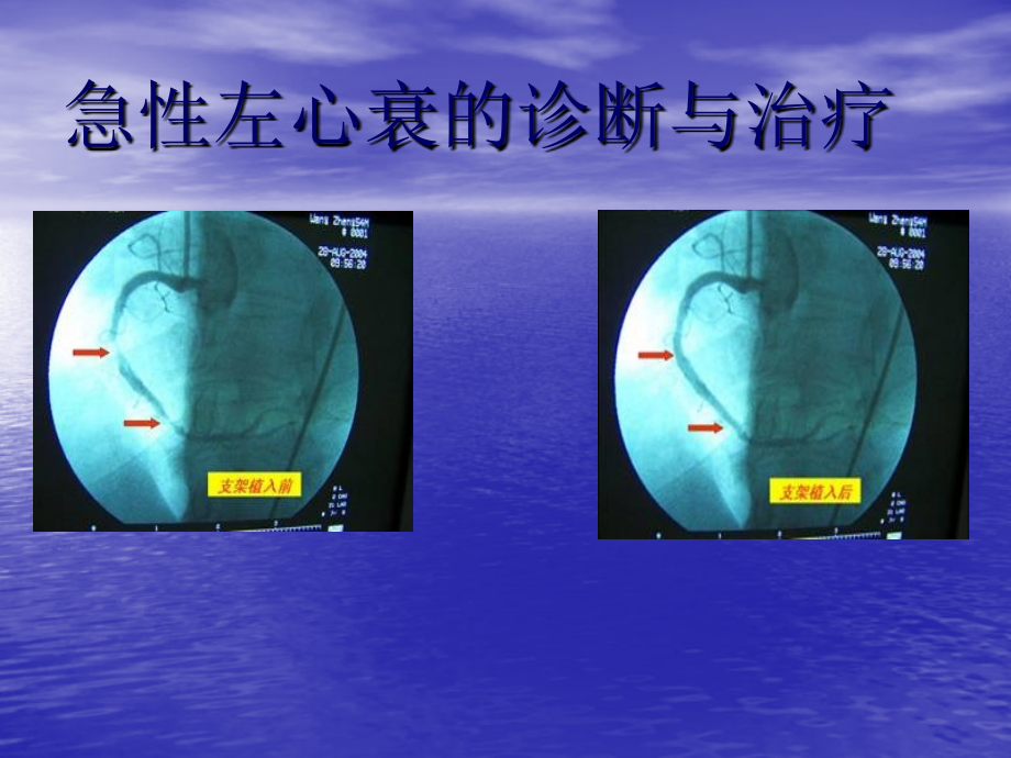 基础医学急性左心衰的诊断与治疗课件_第1页