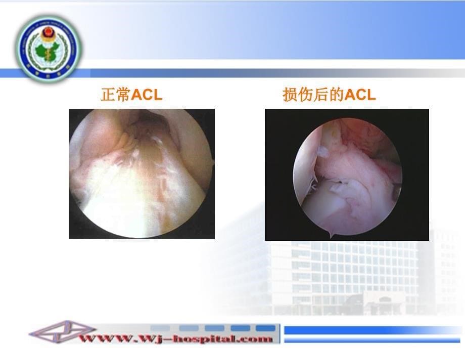 经胫骨隧道的前交叉韧带重建课件_第5页