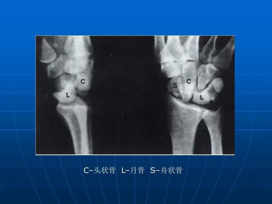 桡骨远端伸直型骨折纸夹板外固定治疗功能康复的观察与总结丰盛医院课件_第5页