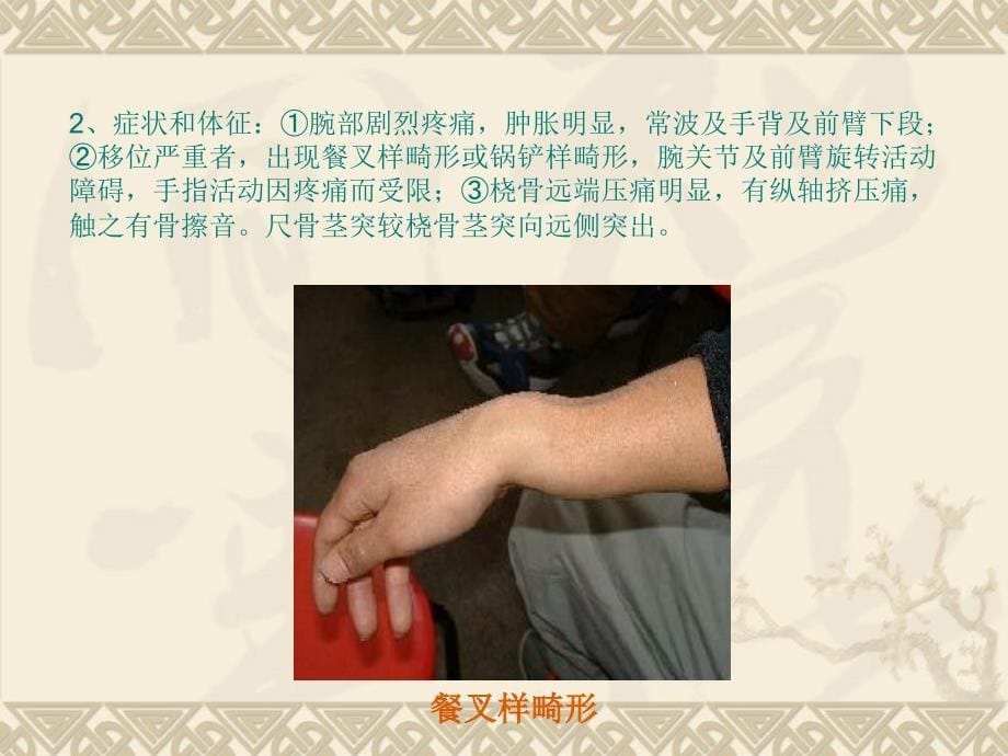 桡骨远端骨折临床路径及诊疗骨伤科课件_第5页