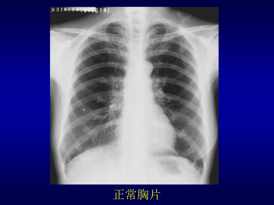 肺 肿 瘤 的 影 像 诊 断 重庆医科大学第二医院放射诊断教研室课件_1_第2页