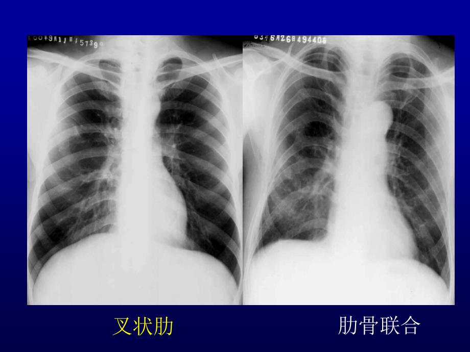 肺 肿 瘤 的 影 像 诊 断 重庆医科大学第二医院放射诊断教研室课件_1_第3页