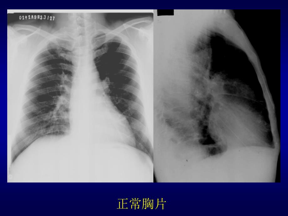肺 肿 瘤 的 影 像 诊 断 重庆医科大学第二医院放射诊断教研室课件_1_第4页