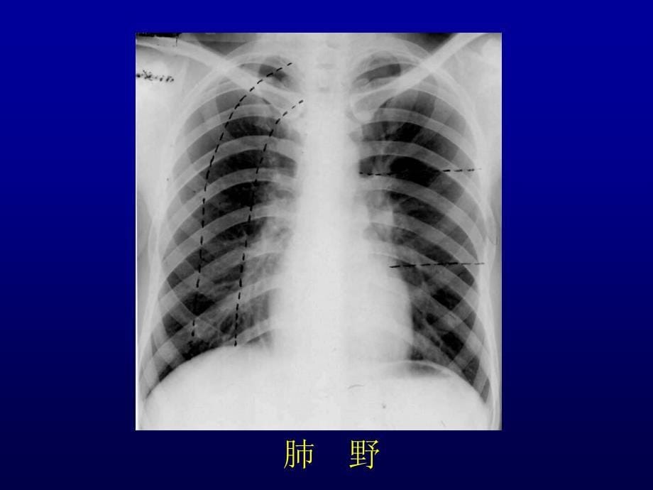 肺 肿 瘤 的 影 像 诊 断 重庆医科大学第二医院放射诊断教研室课件_1_第5页