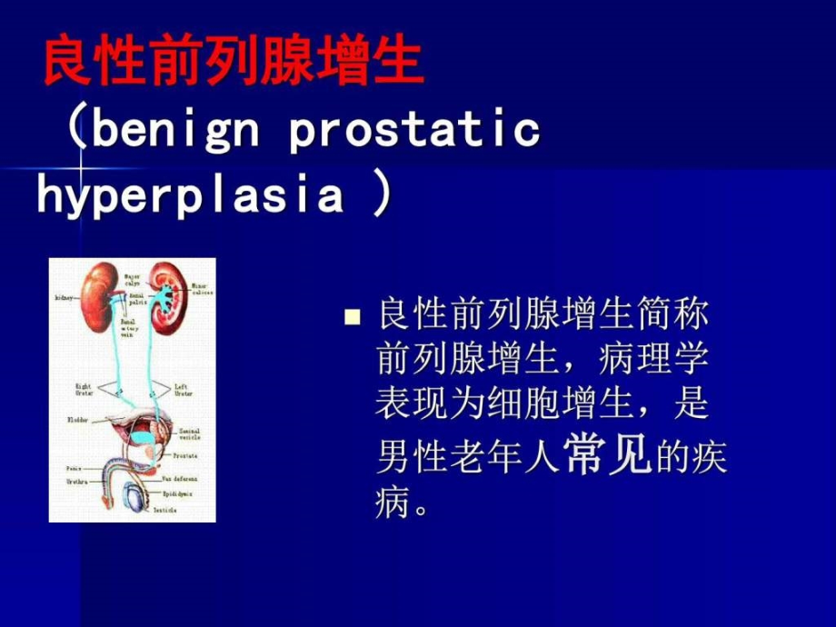 讲课良性前列腺增生症图文课件_第3页