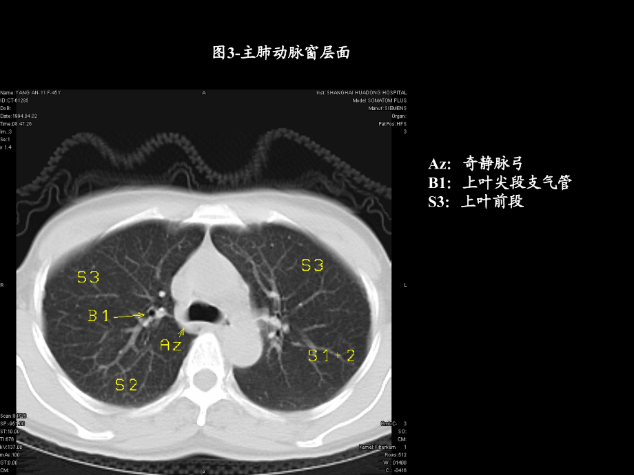 天津医科大学课件-胸部ct解剖与典型病例CT征象_第3页