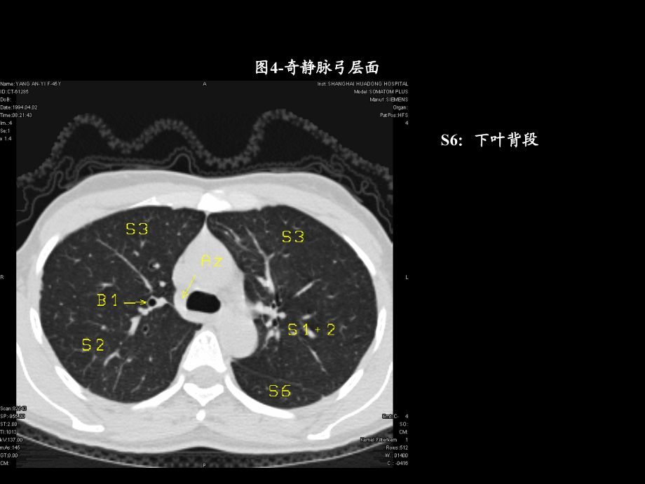 天津医科大学课件-胸部ct解剖与典型病例CT征象_第4页