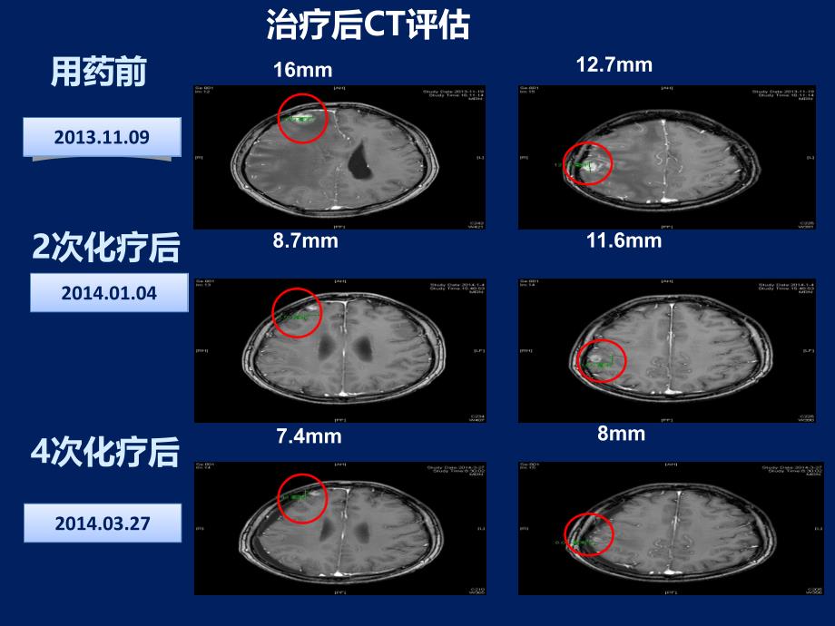 安维汀-肺癌脑转移患者分子靶向治疗疗效和安全性_第3页