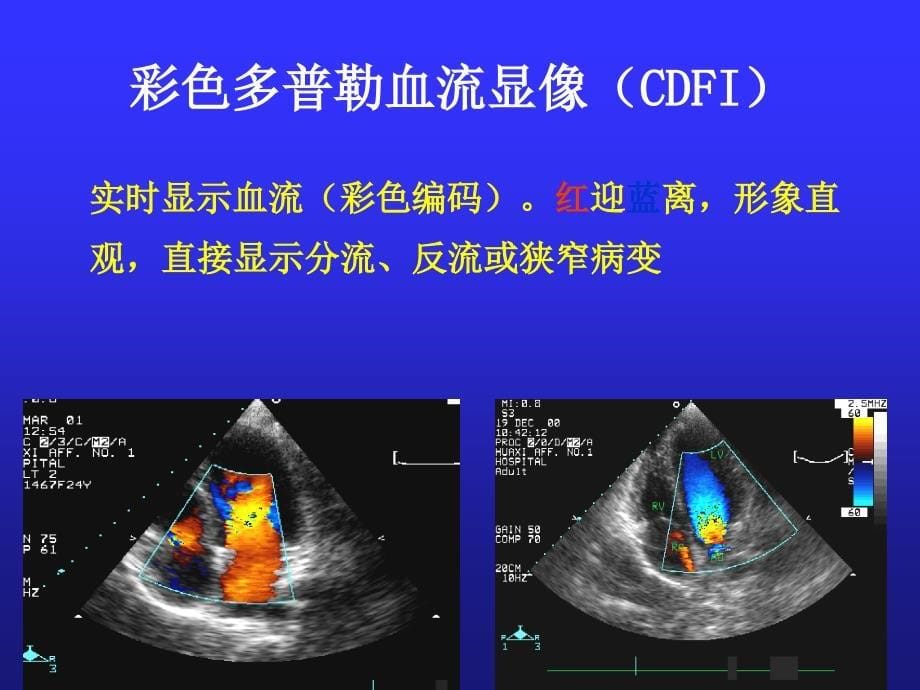 超 声 心 动 图 结 果 解_第5页