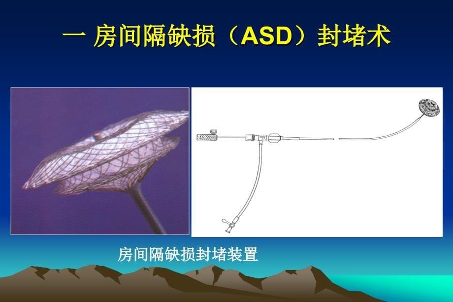 超声心动图在先心病介入治疗中应用介绍_第5页