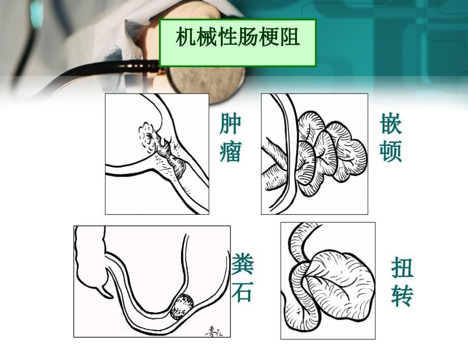 肠梗阻病人护理-12本_第5页