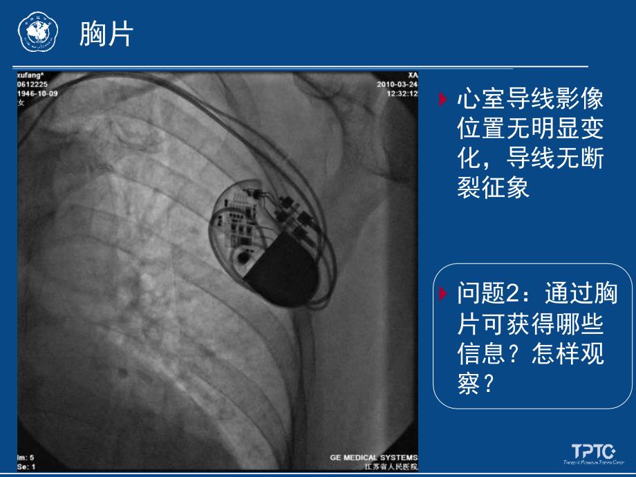 病例五：起搏阈值增高_第4页