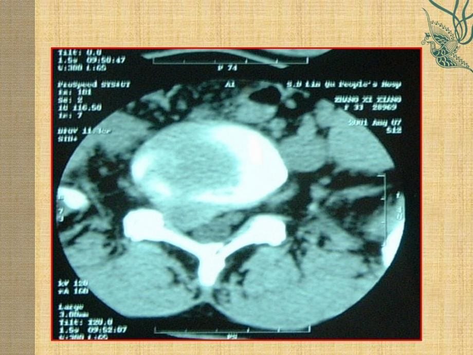 查和萍教授-腰椎间盘突出症_第5页