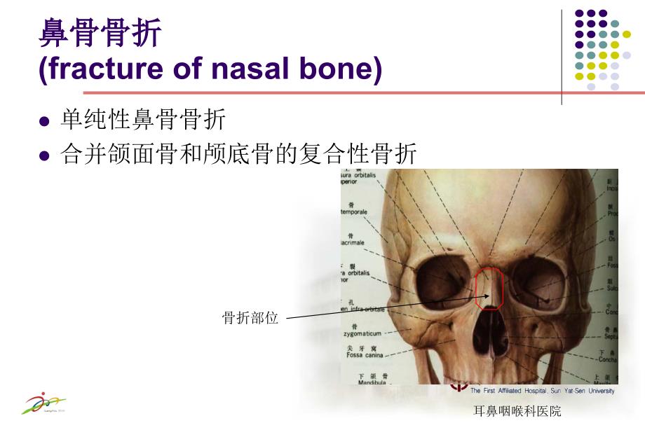 鼻外伤_中山大学附属第一病院精彩课件_第3页