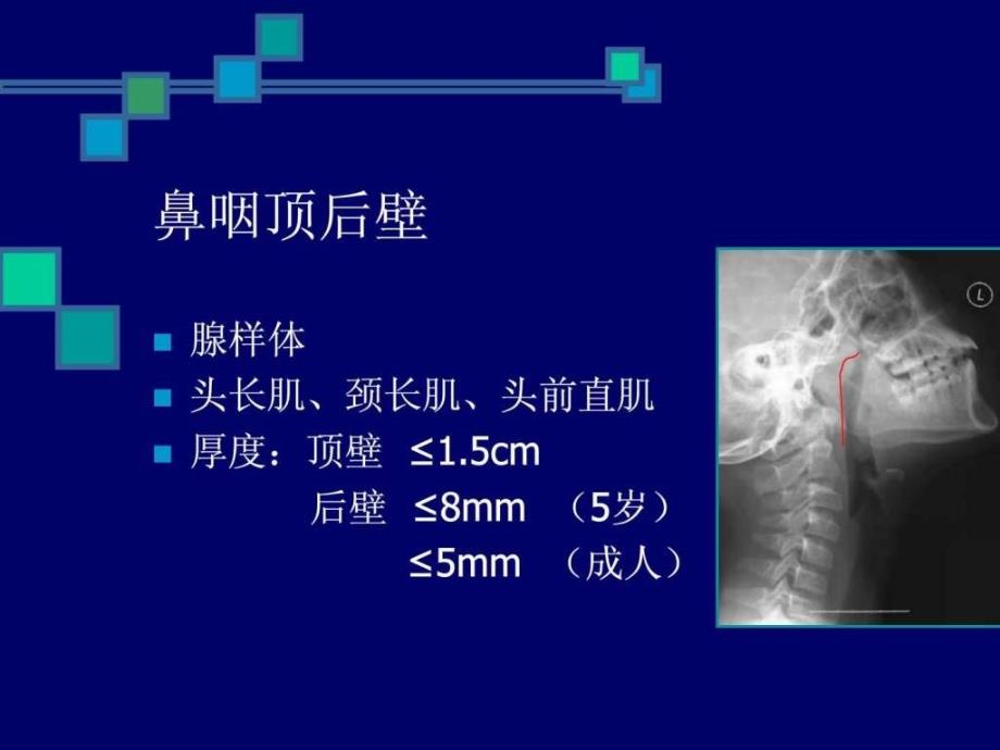 鼻咽与咽旁间隙影像解剖0课件_第4页