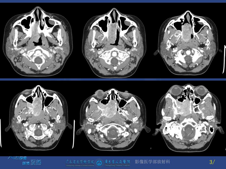 鼻咽纤维血管瘤课件_第3页