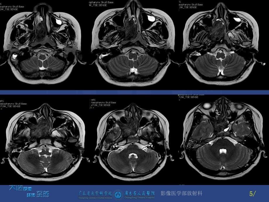 鼻咽纤维血管瘤课件_第5页