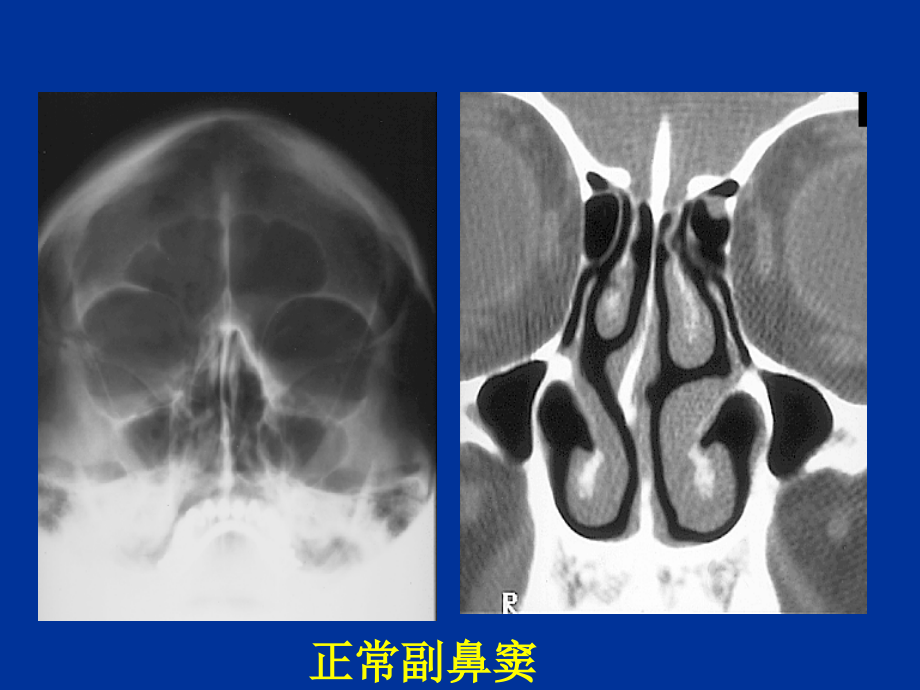 鼻窦疾病实习片_1课件_第3页