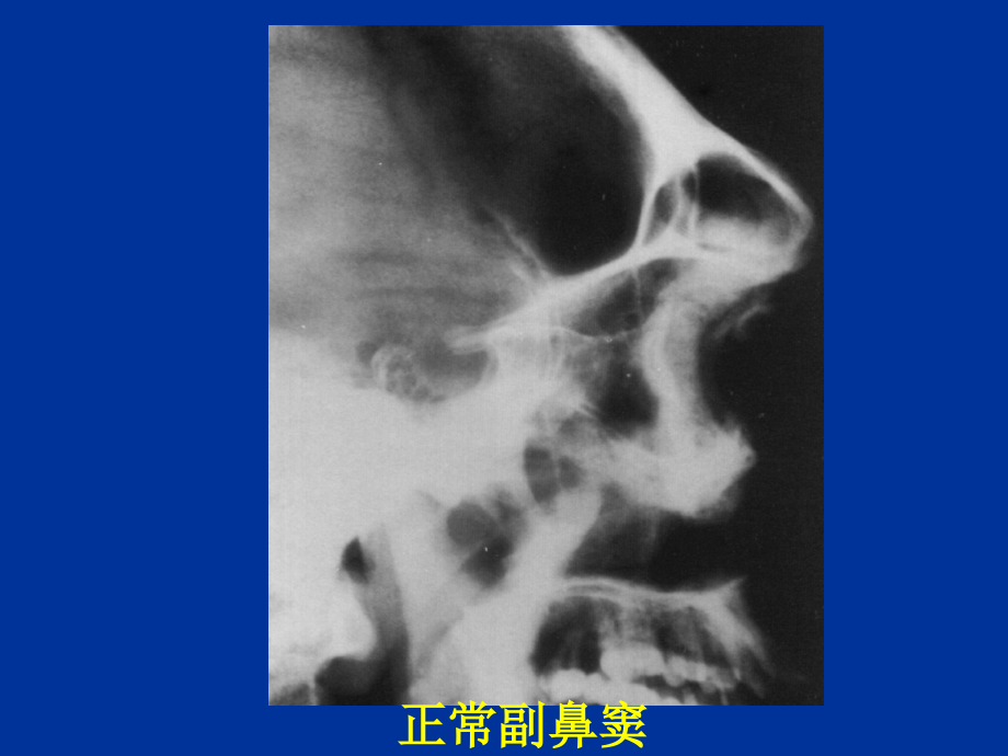 鼻窦疾病实习片_1课件_第4页