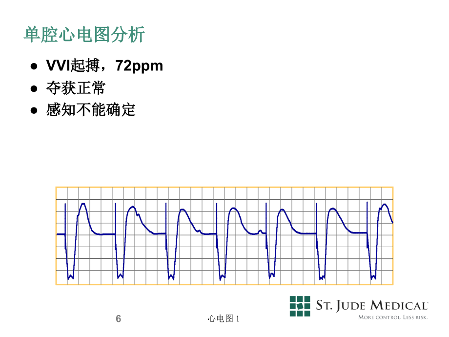 北大人民医院心脏起搏器基础与临床研讨班课件 08single chamber _第3页