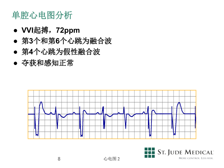 北大人民医院心脏起搏器基础与临床研讨班课件 08single chamber _第4页