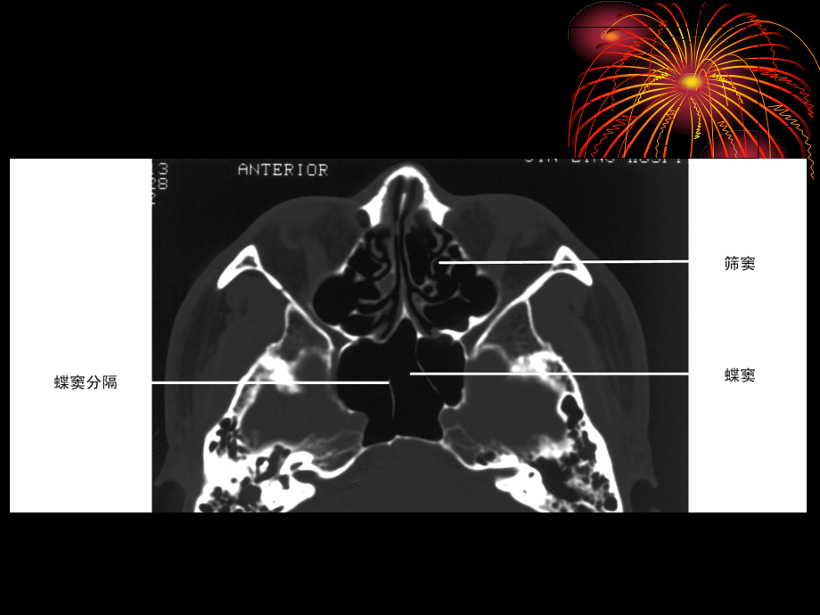 鼻和鼻窦病变ct诊断课件_第3页