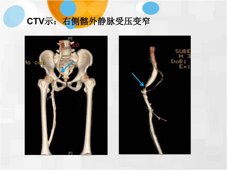 病例讨论血管瘤样纤维组织细胞瘤课件_第3页