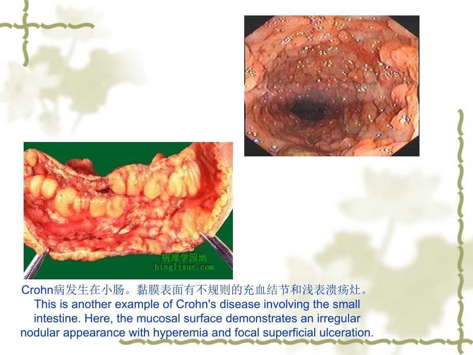 病理学课件_肠炎_第5页