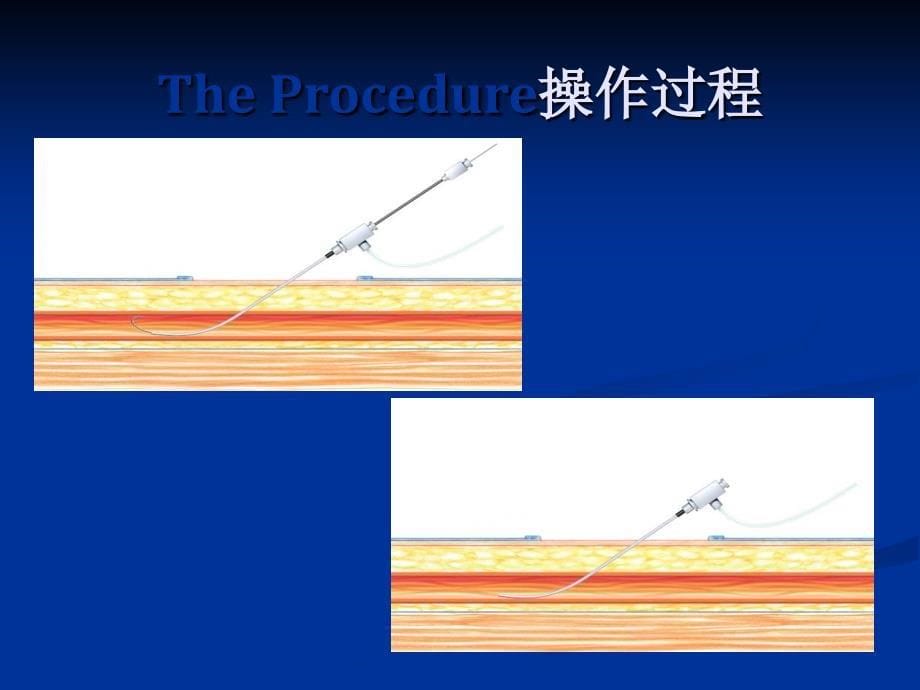 胆道狭窄解剖、生理与手术过程_第5页