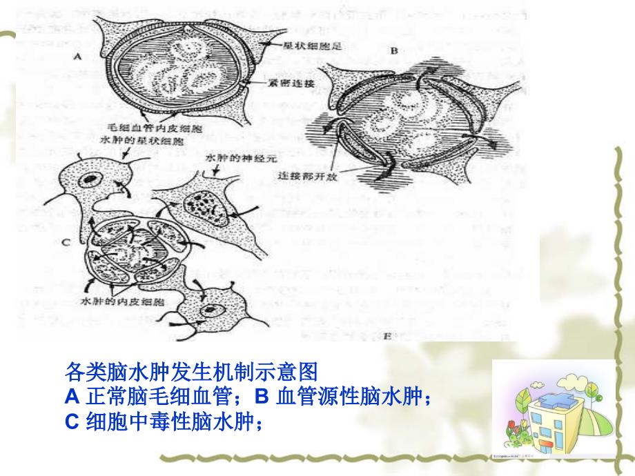 《脑水肿的护理》ppt课件_第4页