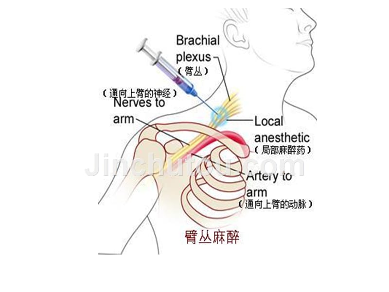 《外周神经阻滞》ppt课件_第4页