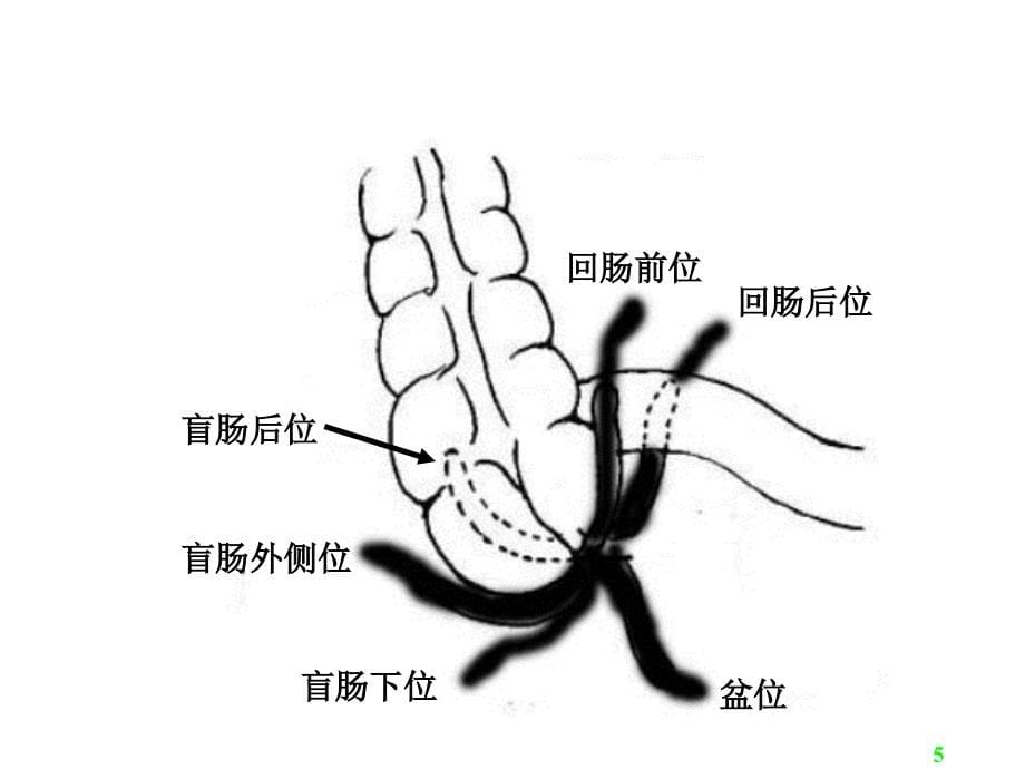 《阑尾炎acutea》ppt课件_第5页