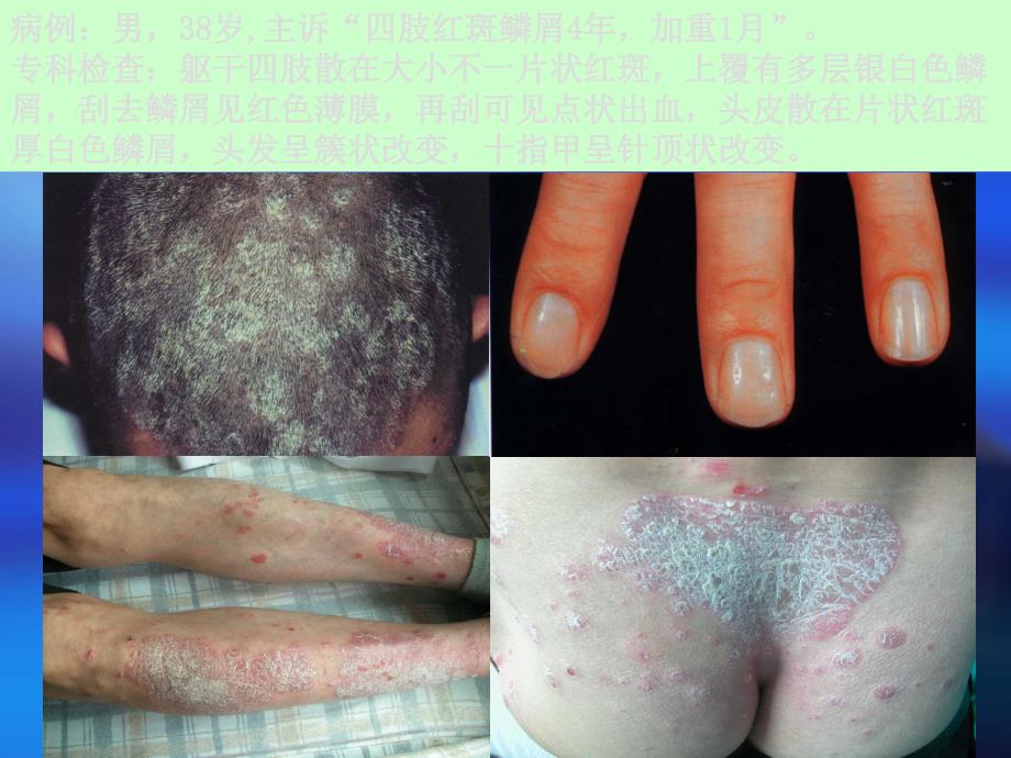 《银屑病psoriasis》ppt课件_第4页