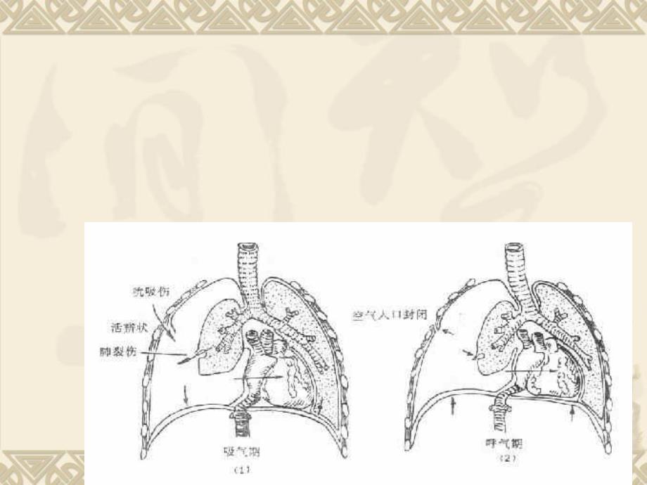 《闭式胸腔引流》ppt课件_第4页