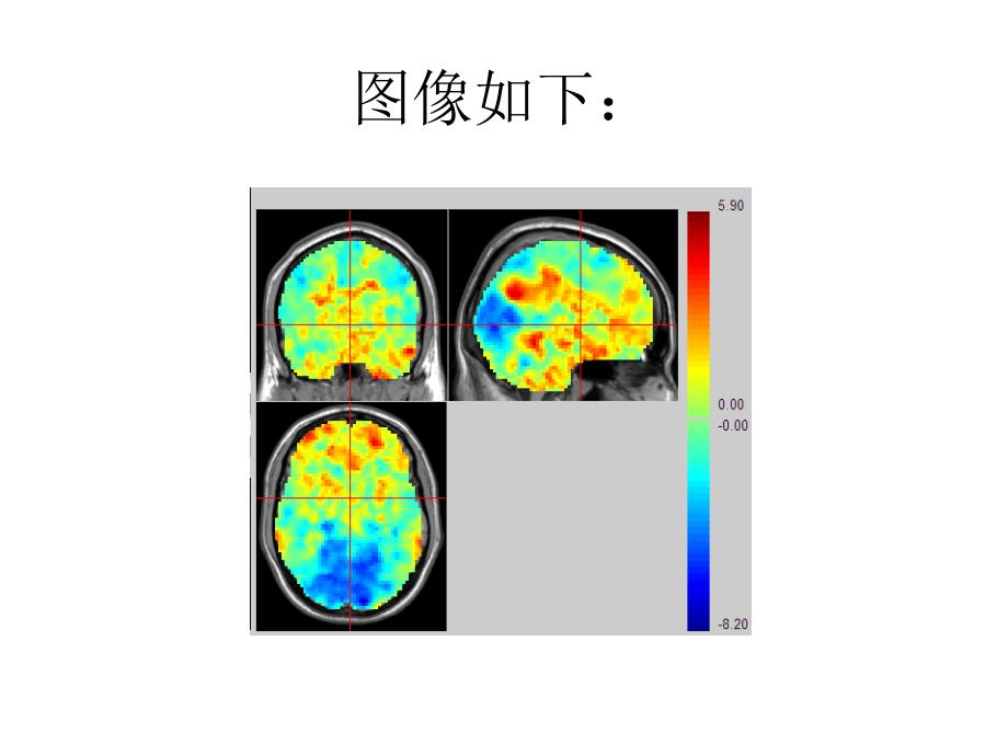 《alphasim校正方法》ppt课件_第3页