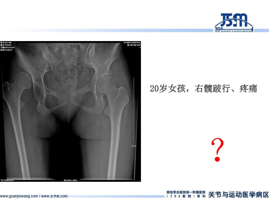 青少年严重髋关节发育不良的手术治疗colonna关节囊成型术_第4页